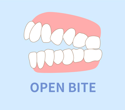 Openbite