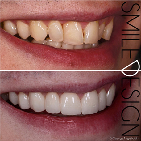 Veneers & Teeth Whitening