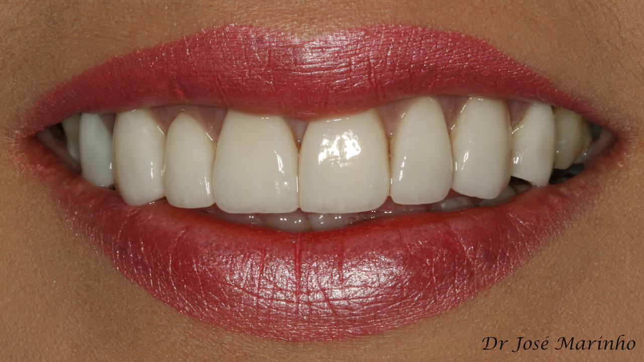Jose_Veneers_After Dental Blog Aura Dental