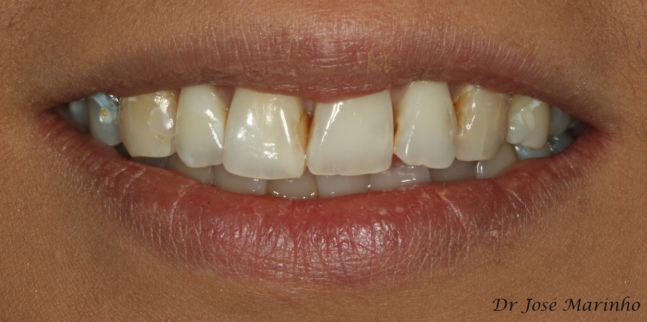 Jose_Veneers_Before Dental Blog Aura Dental
