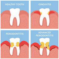periodontal-disease