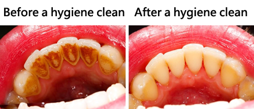 Before after a hygiene clean