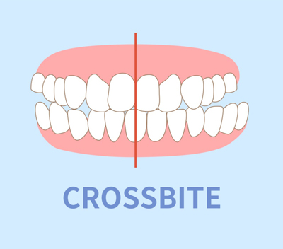 Crossbite
