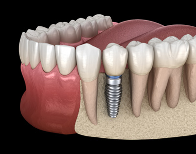 Dental Implants