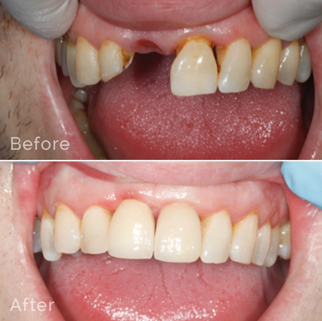 Honest insights into Dental Implant Prices