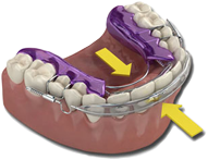 Inman aligner