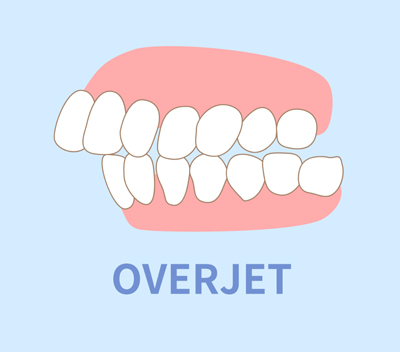 Overjet