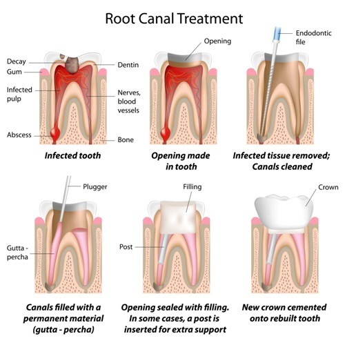 Root Canal