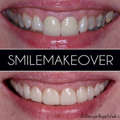 Crowns & Veneers