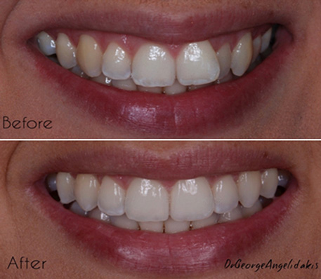 Invisalign Teeth Alignment