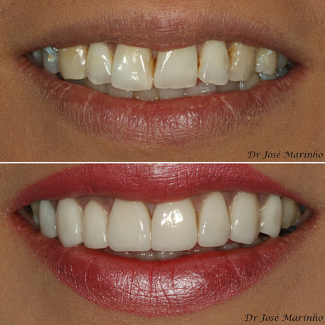 Invisalign Teeth Alignment