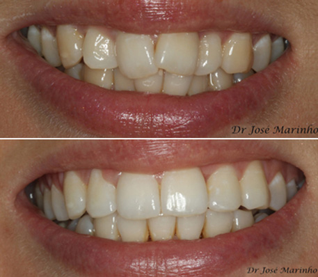 Invisalign Teeth Alignment