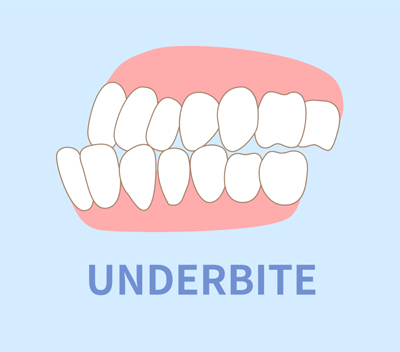 Underbite